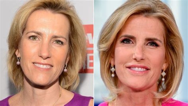 Laura Ingraham Lips, Did Laura Ingraham Get Her Lips